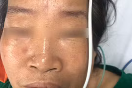 Bị ong lạ đốt, nữ bệnh nhân ở Hà Nội nhồi máu cơ tim cấp, ngừng tuần hoàn