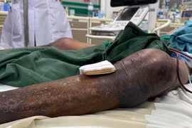 Chỉ từ vết gai đâm, người đàn ông nhập viện với hai chân tím đen, đang thập tử nhất sinh