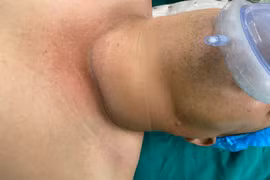 Chủ quan vì nghĩ u tuyến giáp lành tính không cần mổ, nam bệnh nhân diễn biến nặng