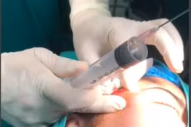 Nữ sinh 16 tuổi ở Bắc Kạn mù mắt do tiêm filler nâng mũi