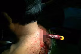 Bị đâm trúng cổ, lái xe ôm thoát chết kỳ diệu