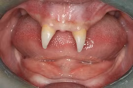 Cậu bé mọc răng như ma cà rồng