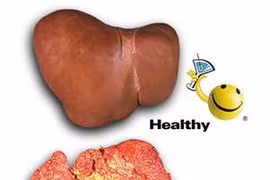 Phát hiện các yếu tố nguy cơ của ung thư gan