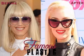 Nghi án Gwen Stefani đụng dao kéo