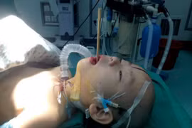 Cậu bé sống sót thần kì dù bị đũa đâm thẳng vào não 