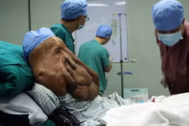 Người đàn ông khổ sở với khối u 17.5 kg trên mặt