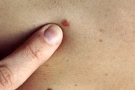 Các cách bảo vệ da và ngăn chặn ung thư da