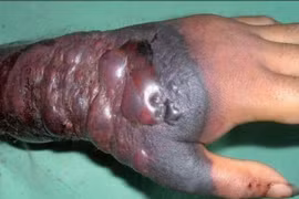 Nhân viên sứ quán Mỹ bị “trả về” vì nghi nhiễm Ebola