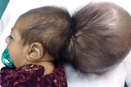 Bé gái hai đầu được phẫu thuật thành công