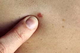 Nhận diện các dấu hiệu cảnh báo ung thư da