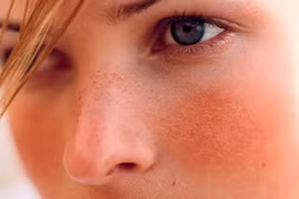 Bệnh rosacea liên quan đến Alzheimer