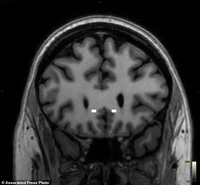 Máy tạo nhịp tim cho não điều trị trầm cảm nặng