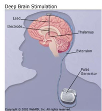 Máy tạo nhịp tim cho não điều trị trầm cảm nặng