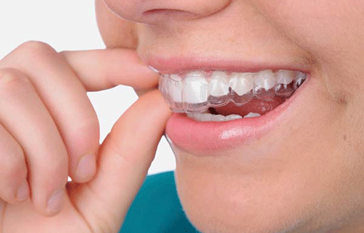 Khắc phục chứng nghiến răng ở trẻ ảnh 1 Khắc phục chứng nghiến răng ở trẻ ảnh 1