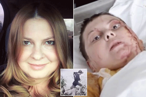 Đòn trả thù hèn hạ bằng axit nhằm vào nữ Phó Thị trưởng chống tham nhũng ảnh 1