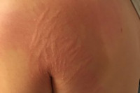 [ẢNH] Kỳ lạ chứng da vẽ nổi xuất hiện trên cơ thể con người 