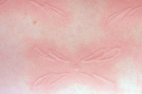 [ẢNH] Kỳ lạ chứng da vẽ nổi xuất hiện trên cơ thể con người 