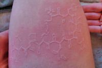 [ẢNH] Kỳ lạ chứng da vẽ nổi xuất hiện trên cơ thể con người 