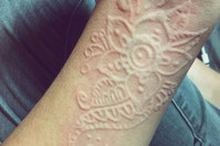 [ẢNH] Kỳ lạ chứng da vẽ nổi xuất hiện trên cơ thể con người 