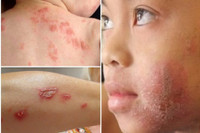 [Ảnh] Nhận diện những dấu hiệu tổn thương do kiến ba khoang và cách xử lý 