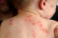 [Ảnh] Nhận diện những dấu hiệu tổn thương do kiến ba khoang và cách xử lý 