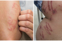 [Ảnh] Nhận diện những dấu hiệu tổn thương do kiến ba khoang và cách xử lý 