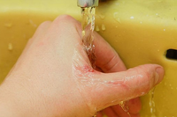 [Ảnh] Nhận diện những dấu hiệu tổn thương do kiến ba khoang và cách xử lý 