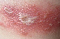 [Ảnh] Nhận diện những dấu hiệu tổn thương do kiến ba khoang và cách xử lý 