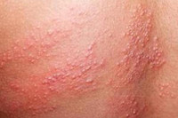 [Ảnh] Nhận diện những dấu hiệu tổn thương do kiến ba khoang và cách xử lý 