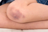 [Ảnh] Nhận diện những dấu hiệu tổn thương do kiến ba khoang và cách xử lý 