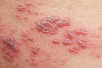 [Ảnh] Nhận diện những dấu hiệu tổn thương do kiến ba khoang và cách xử lý 