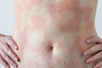 [ẢNH] Kỳ lạ chứng da vẽ nổi xuất hiện trên cơ thể con người 