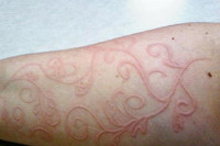 [ẢNH] Kỳ lạ chứng da vẽ nổi xuất hiện trên cơ thể con người 