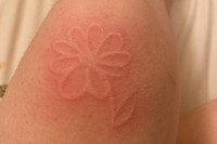 [ẢNH] Kỳ lạ chứng da vẽ nổi xuất hiện trên cơ thể con người 