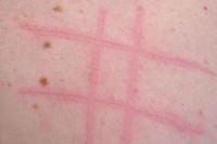 [ẢNH] Kỳ lạ chứng da vẽ nổi xuất hiện trên cơ thể con người 