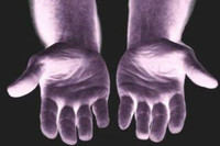 [ẢNH] Giải mã bí ẩn về những người không có dấu vân tay