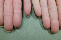 [ẢNH] Giải mã bí ẩn về những người không có dấu vân tay