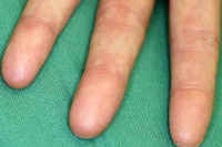 [ẢNH] Giải mã bí ẩn về những người không có dấu vân tay