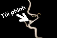 [ẢNH] Đột quỵ gia tăng ở người trẻ: Những dấu hiệu bất thường không nên bỏ qua