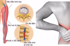 Nguy cơ mắc bệnh thoát vị đĩa đệm do thói quen ngồi lâu