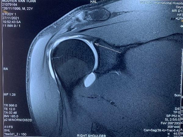 Phim MRI khi có tiêm thuốc thấy rõ tổn thương hơn