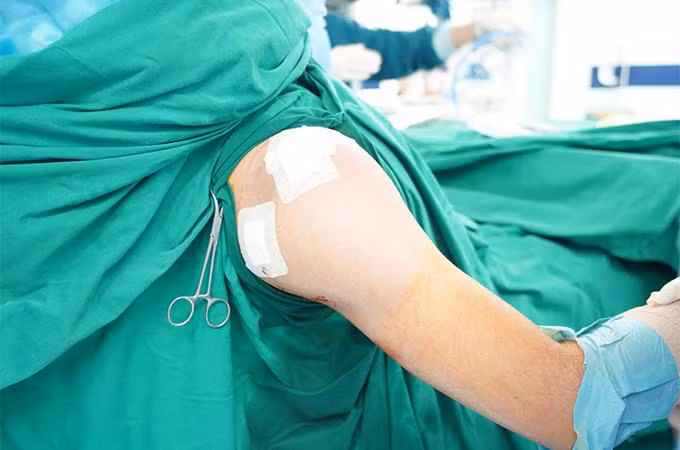 Hình ảnh vị trí chấn thương sau phẫu thuật nội soi, tỉ lệ xâm lấn rất nhỏ Hình ảnh vị trí chấn thương sau phẫu thuật nội soi, tỉ lệ xâm lấn rất nhỏ