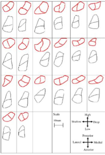 Hình dạng và kích thước vùng bám của dây chằng chéo trước vào xương đùi (ở trên) và xương chày (ở dưới) ở 20 người trong một nghiên cứu.