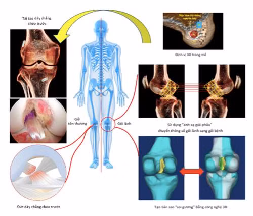 Phương pháp “ánh xạ giải phẫu” sử dụng công nghệ định vị 3D trong phẫu thuật tái tạo dây chằng chéo trước (hình minh hoạ)