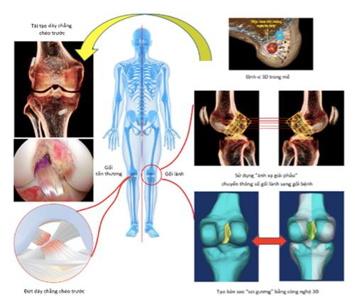 Phương pháp “ánh xạ giải phẫu” sử dụng công nghệ định vị 3D trong phẫu thuật tái tạo dây chằng chéo trước (hình minh hoạ)
