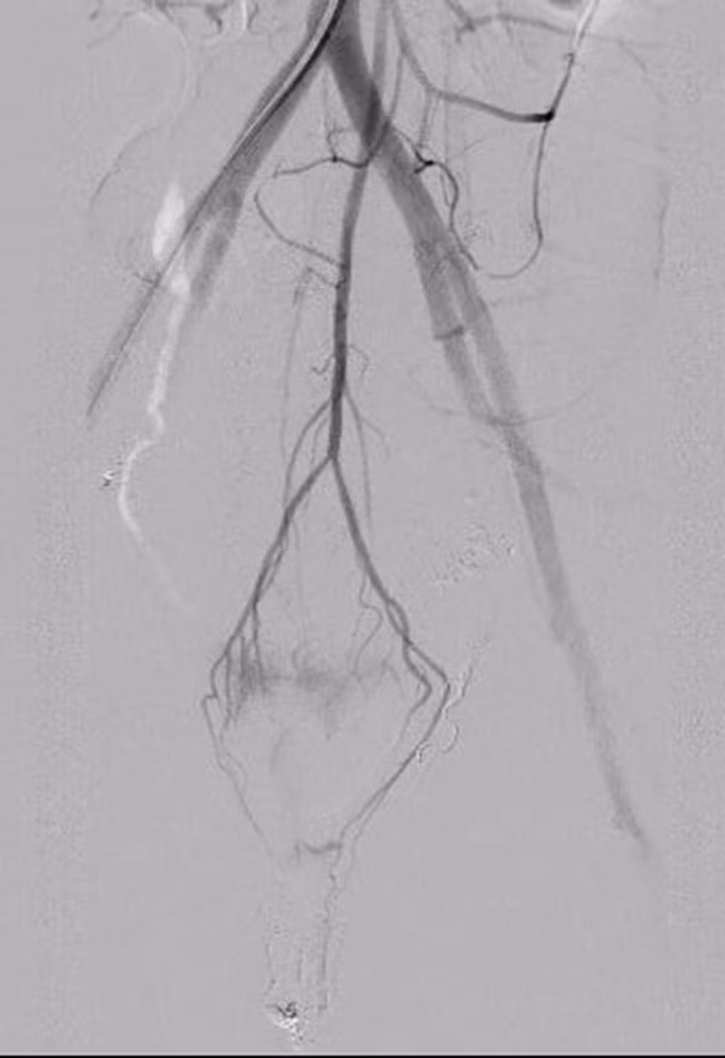 Sau nút mạch động mạch mạc treo tràng dưới Sau nút mạch động mạch mạc treo tràng dưới