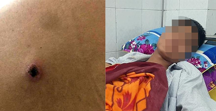 Anh Đ hiện đang điều trị tại bệnh viện cùng với vết thương Anh Đ hiện đang điều trị tại bệnh viện cùng với vết thương