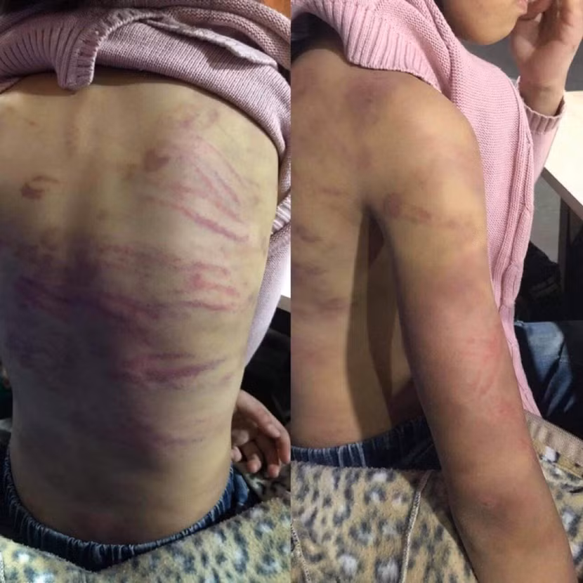 Hình ảnh bé B. được cho là bị mẹ đẻ và "người tình" bạo hành