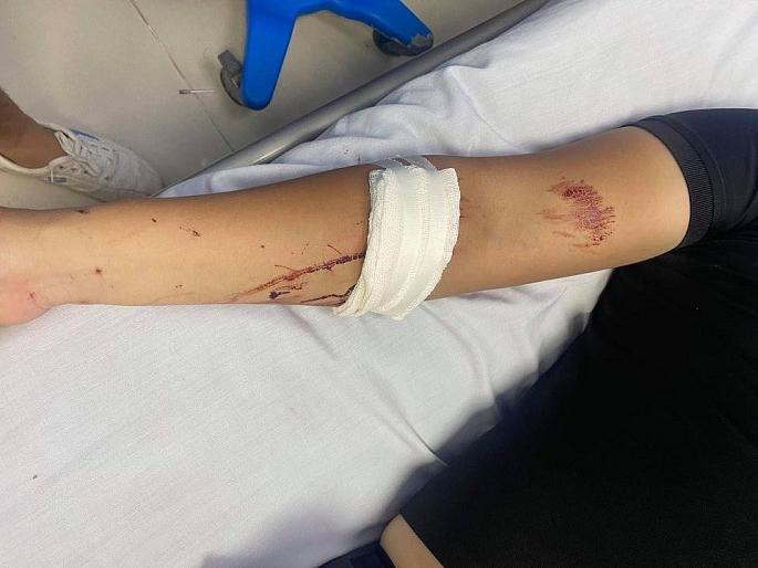 Một trong 2 nam nhân viên cấp cứu tại bệnh vện sau khi bị nhóm thanh niên lạ mặt hành hung Một trong 2 nam nhân viên cấp cứu tại bệnh vện sau khi bị nhóm thanh niên lạ mặt hành hung