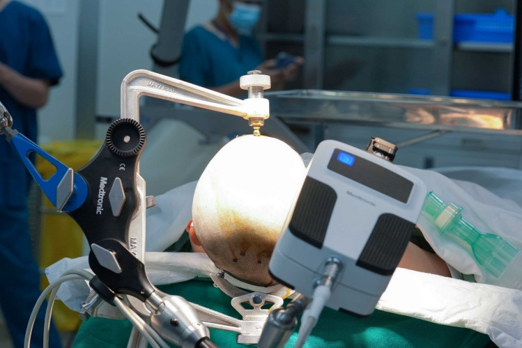 Cánh tay Robot AutoGuide giúp bác sĩ đặt điện cực vào nội sọ được chính xác và nhanh chóng Cánh tay Robot AutoGuide giúp bác sĩ đặt điện cực vào nội sọ được chính xác và nhanh chóng